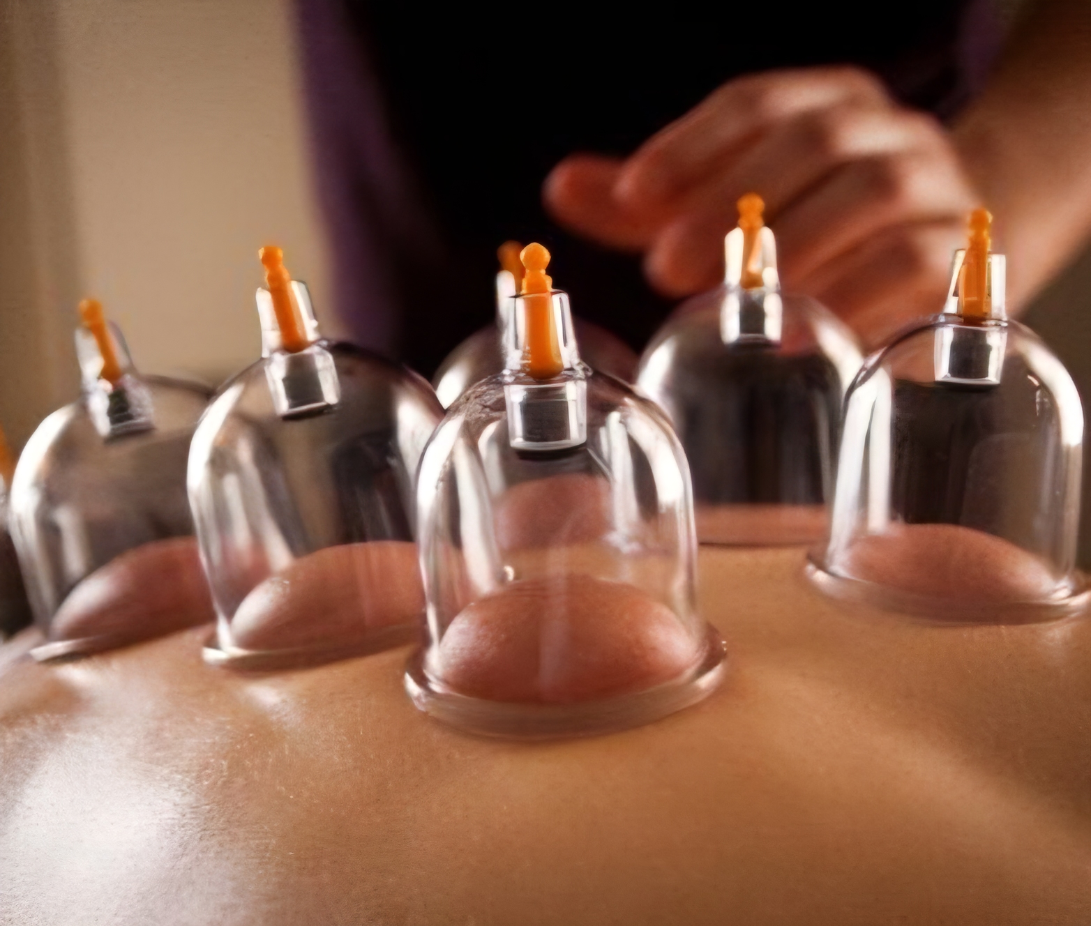 Cupping Therapy